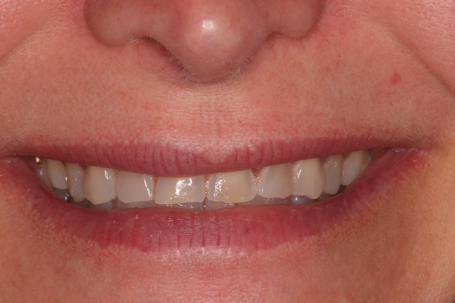 Composite Veneers Droitwich Droitwich Dental Studio