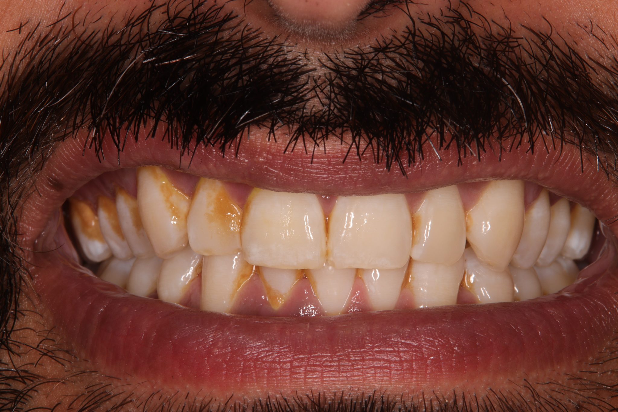 Dental Hygienist Droitwich Droitwich Dental Studio