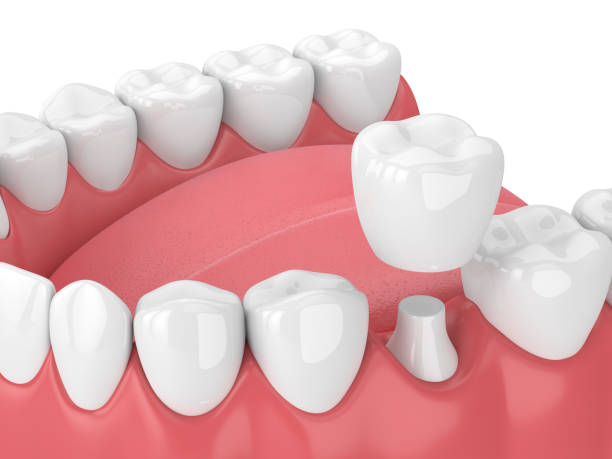 Dental Crowns Droitwich