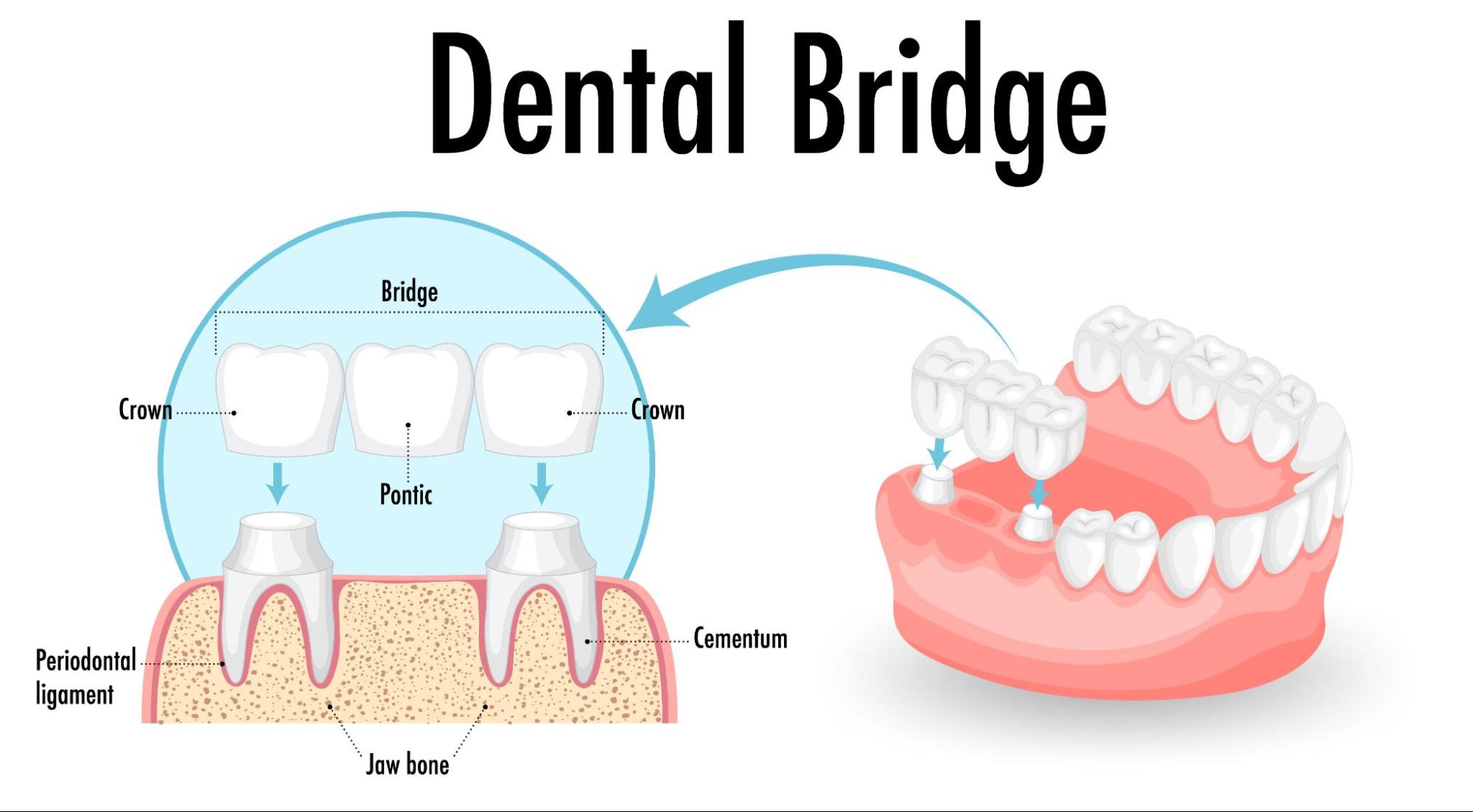 Dental Bridges Droitwich