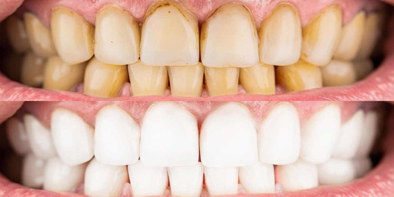 Gum Disease: Causes, Symptoms, and Effective Treatments