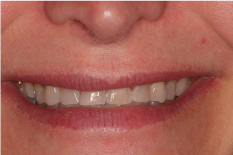 https://droitwichdentalstudio.co.uk/wp-content/uploads/2024/03/com-before.png