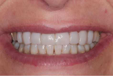 https://droitwichdentalstudio.co.uk/wp-content/uploads/2024/03/om-p-after.png