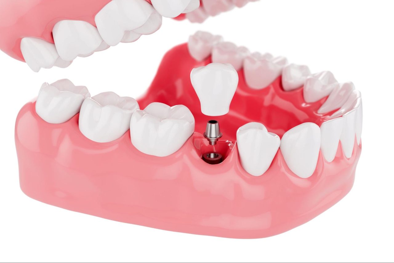 3d render of tooth model