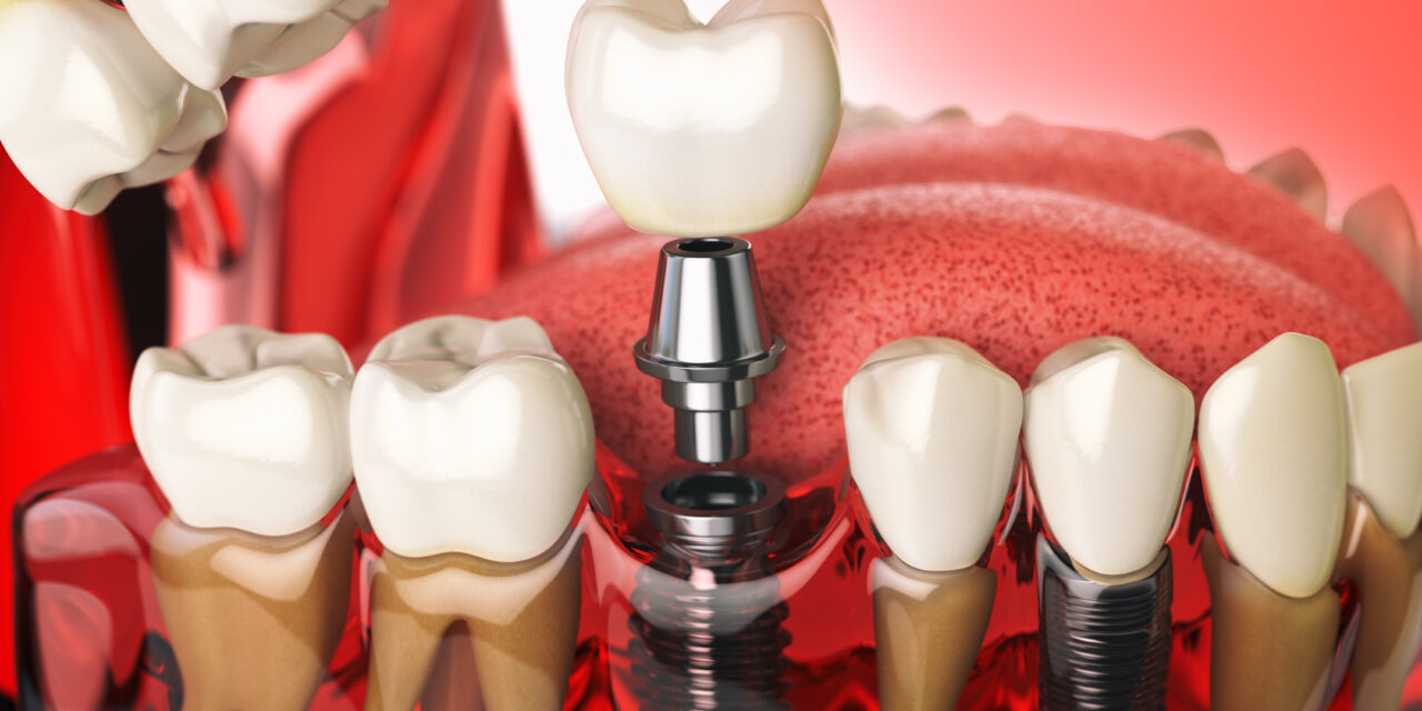 The Long-Term Benefits of Choosing Dental Implants in Droitwich