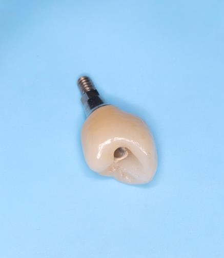 Dental Implant Droitwich