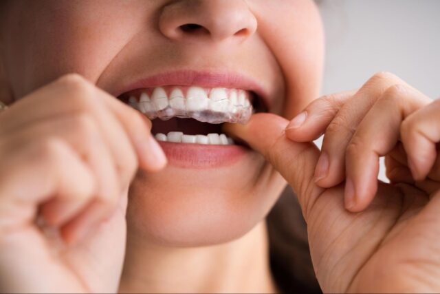 Invisalign Droitwich