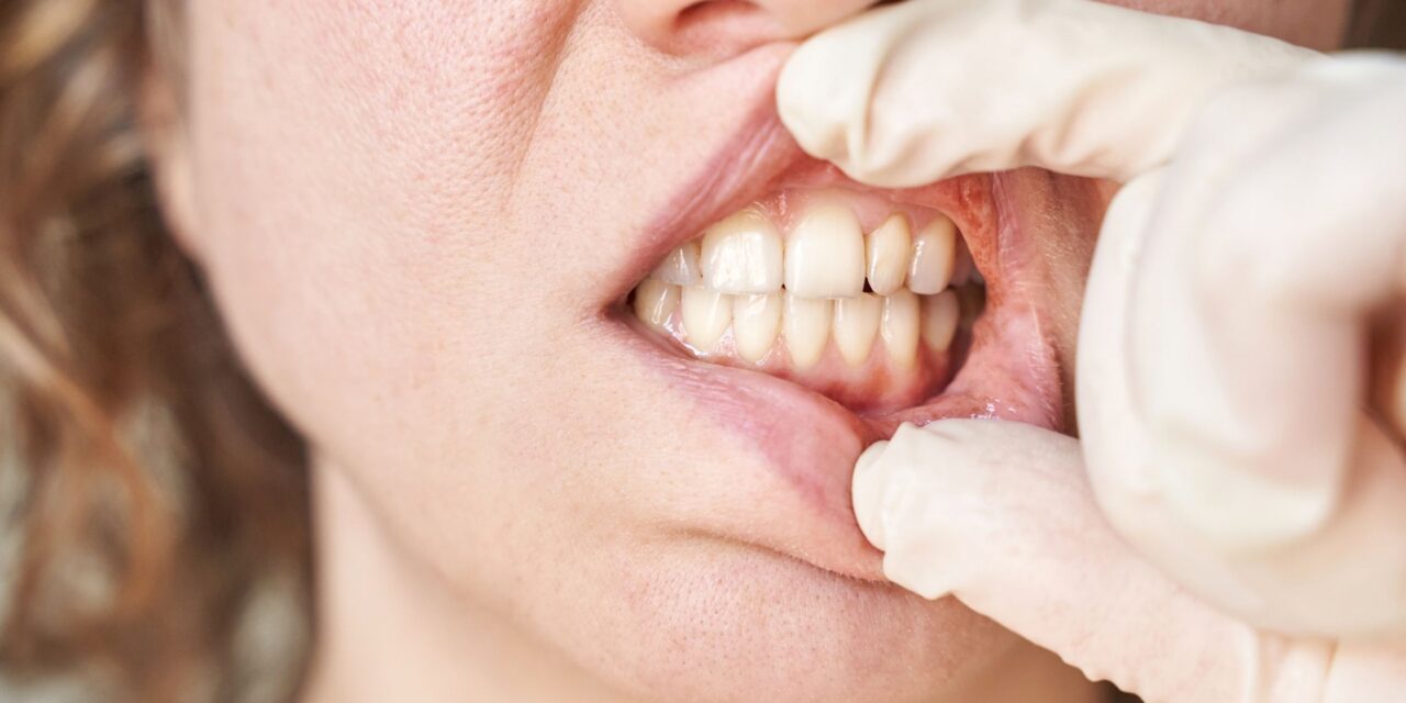 Why Do My Gums Bleed When I Brush? Causes & What to Do